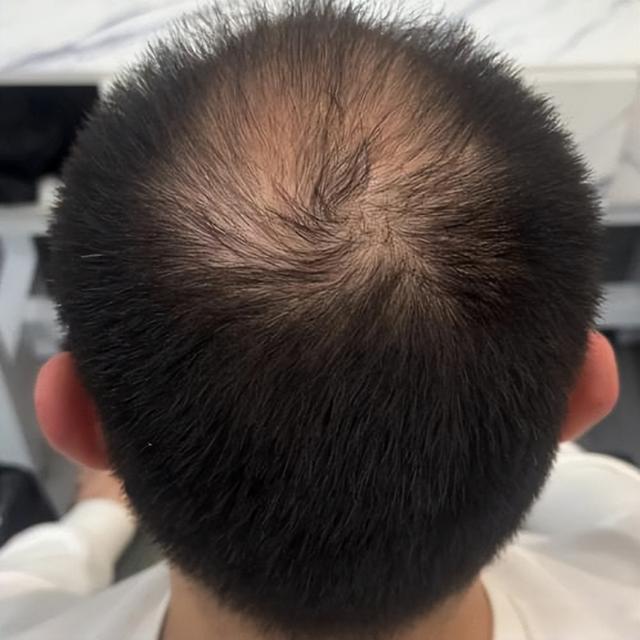 男性脂溢性脱发缠人？揪根源 + 护细节秀发能重生！